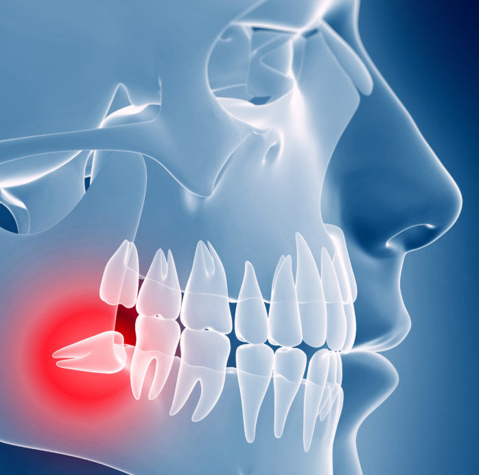 Wisdom Tooth Removal